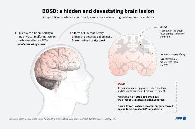 AI tool helps researchers treat child epilepsy